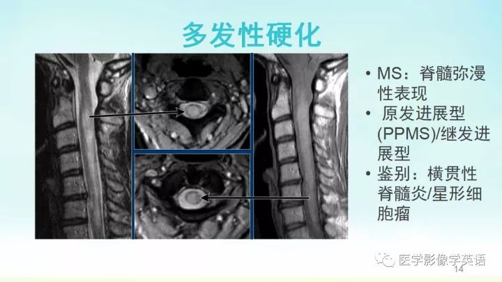 【PPT】脊髓病例