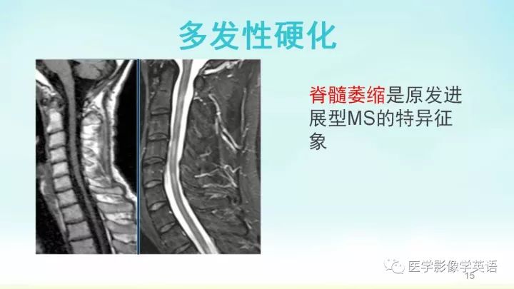 【PPT】脊髓病例