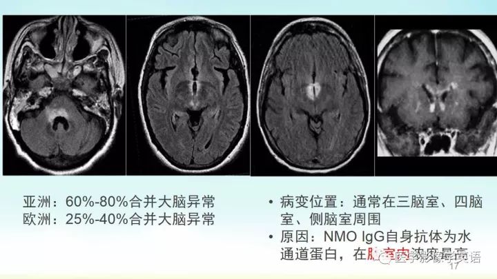 【PPT】脊髓病例
