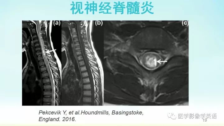 【PPT】脊髓病例