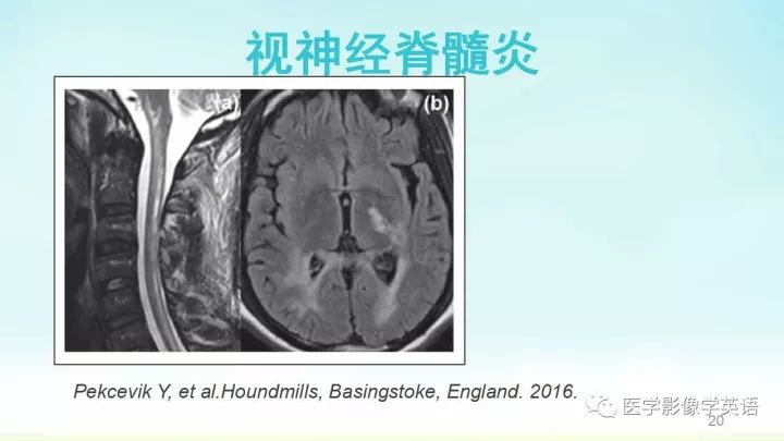 【PPT】脊髓病例