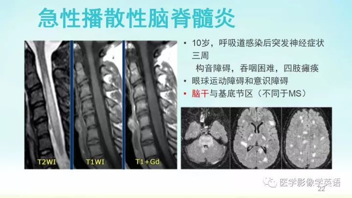 【PPT】脊髓病例
