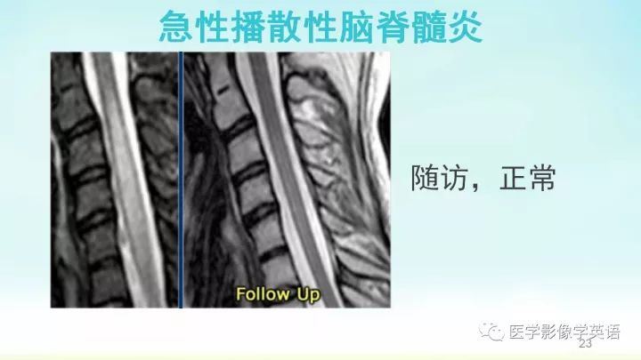 【PPT】脊髓病例