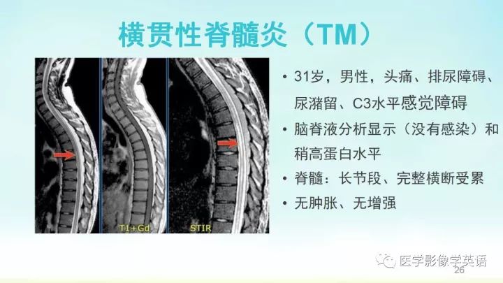 【PPT】脊髓病例