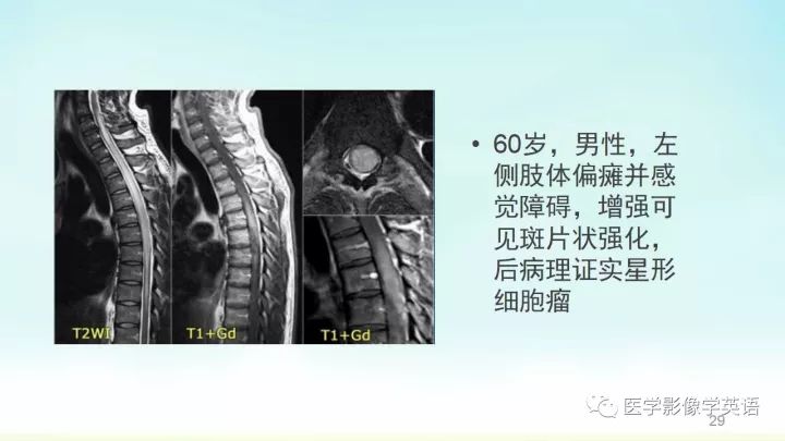 【PPT】脊髓病例