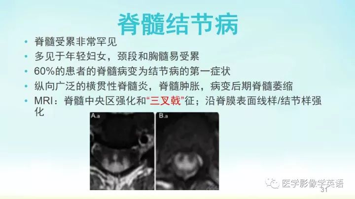 【PPT】脊髓病例