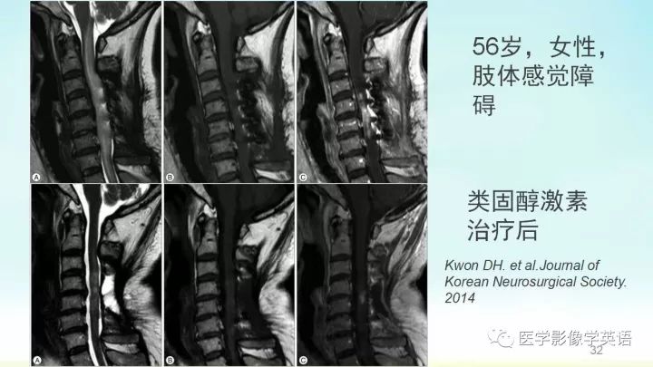 【PPT】脊髓病例