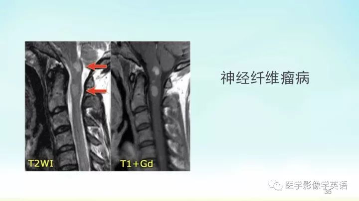 【PPT】脊髓病例