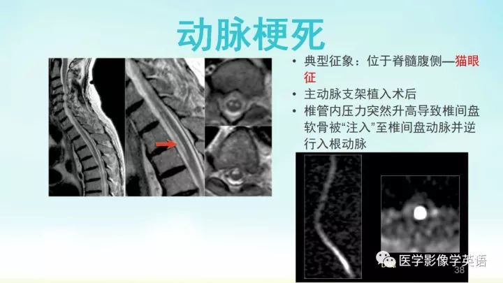 【PPT】脊髓病例