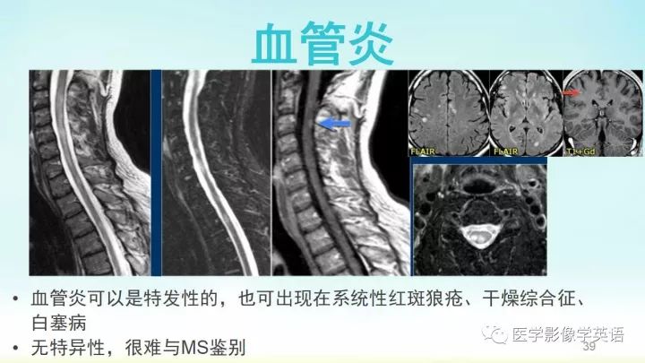 【PPT】脊髓病例