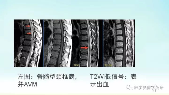 【PPT】脊髓病例