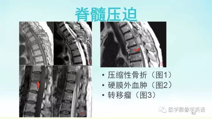 【PPT】脊髓病例