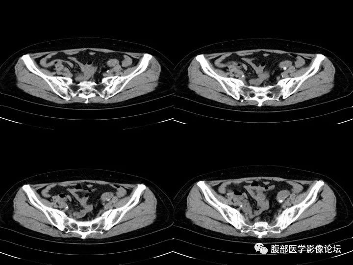 【病例】降乙结肠憩室病并憩室炎1例CT影像表现 【病例】降乙结肠憩室病并憩室炎1例CT影像表现