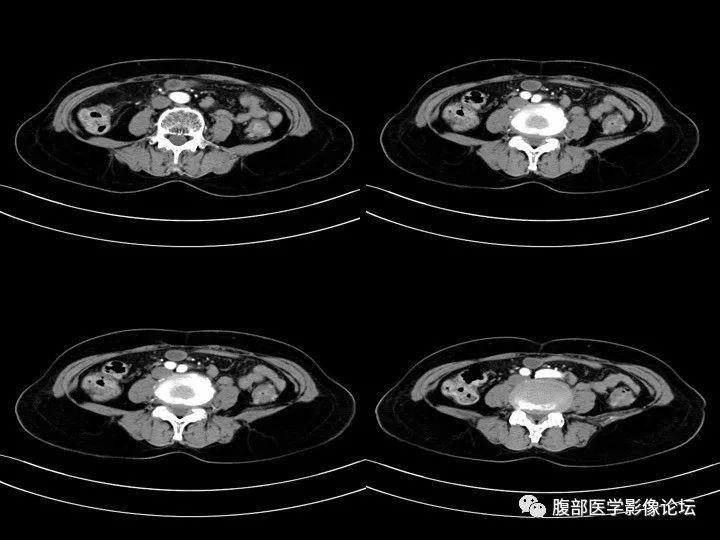 【病例】降乙结肠憩室病并憩室炎1例CT影像表现 【病例】降乙结肠憩室病并憩室炎1例CT影像表现