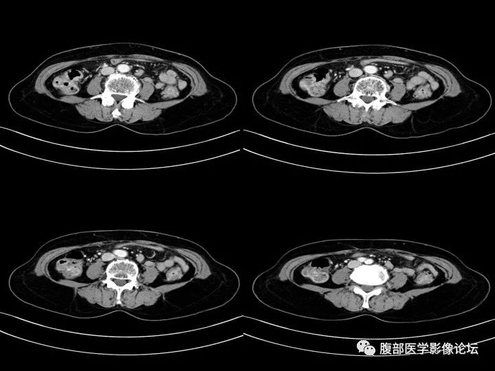 【病例】降乙结肠憩室病并憩室炎1例CT影像表现 【病例】降乙结肠憩室病并憩室炎1例CT影像表现