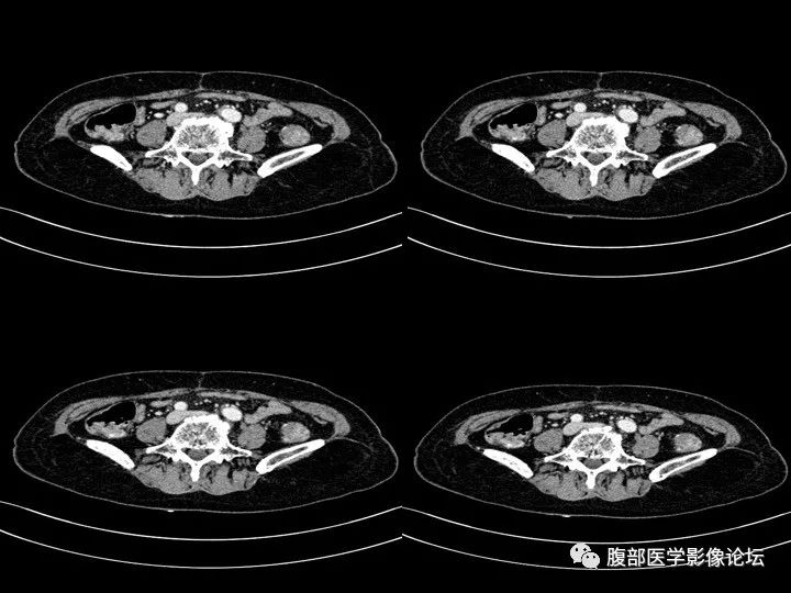 【病例】降乙结肠憩室病并憩室炎1例CT影像表现 【病例】降乙结肠憩室病并憩室炎1例CT影像表现