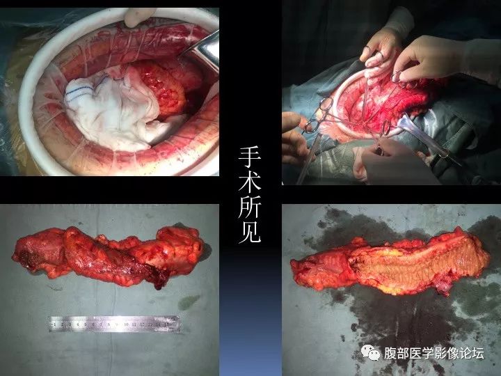 【病例】降乙结肠憩室病并憩室炎1例CT影像表现 【病例】降乙结肠憩室病并憩室炎1例CT影像表现