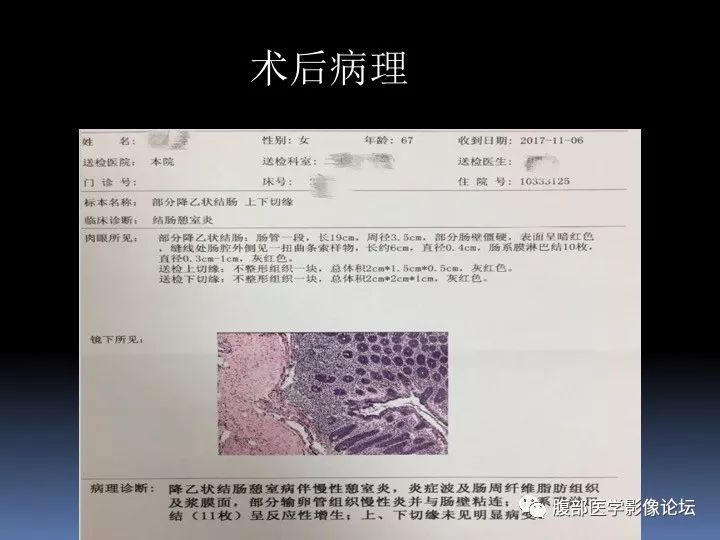 【病例】降乙结肠憩室病并憩室炎1例CT影像表现 【病例】降乙结肠憩室病并憩室炎1例CT影像表现