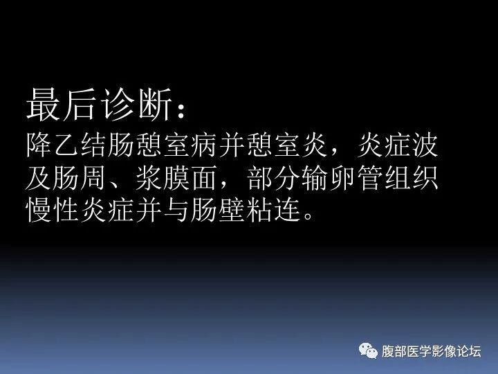 【病例】降乙结肠憩室病并憩室炎1例CT影像表现 【病例】降乙结肠憩室病并憩室炎1例CT影像表现