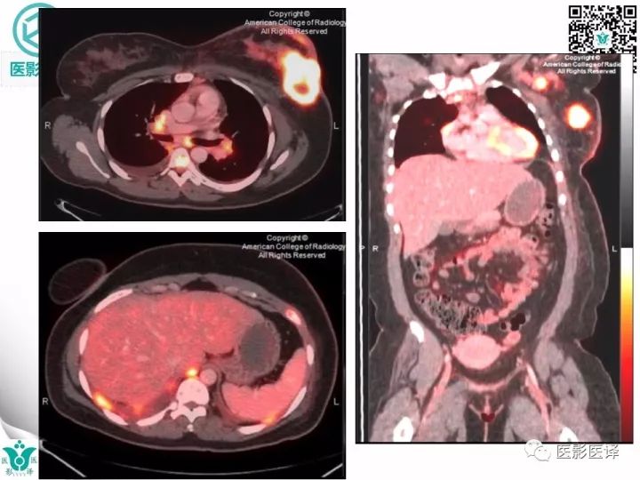 【病例】乳腺癌伴颅底转移至颈动脉管1例PET/CT