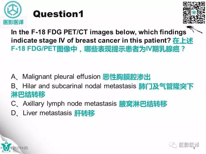 【病例】乳腺癌伴颅底转移至颈动脉管1例PET/CT