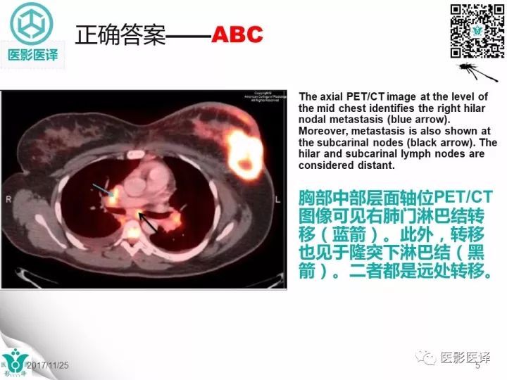 【病例】乳腺癌伴颅底转移至颈动脉管1例PET/CT