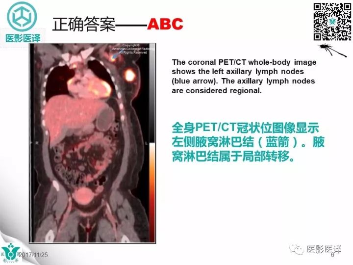 【病例】乳腺癌伴颅底转移至颈动脉管1例PET/CT
