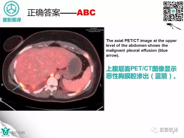 【病例】乳腺癌伴颅底转移至颈动脉管1例PET/CT