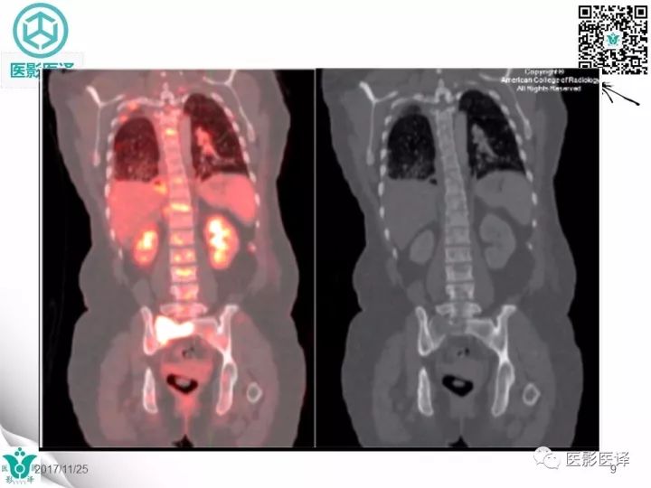 【病例】乳腺癌伴颅底转移至颈动脉管1例PET/CT