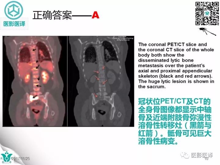 【病例】乳腺癌伴颅底转移至颈动脉管1例PET/CT