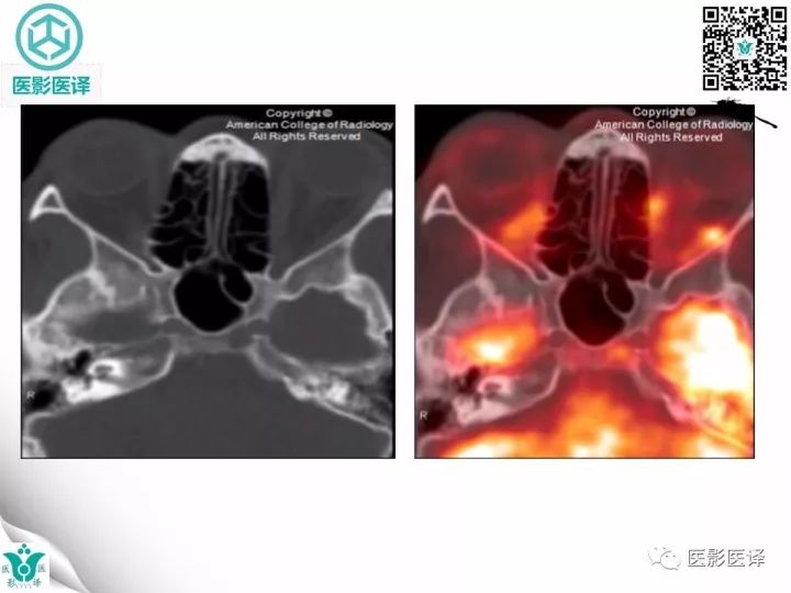 【病例】乳腺癌伴颅底转移至颈动脉管1例PET/CT