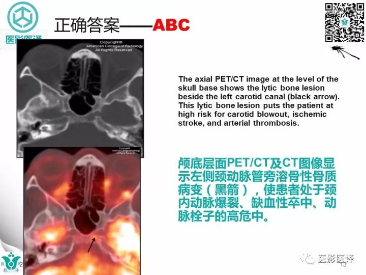 【病例】乳腺癌伴颅底转移至颈动脉管1例PET/CT