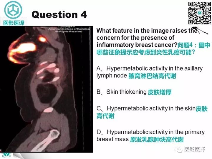 【病例】乳腺癌伴颅底转移至颈动脉管1例PET/CT