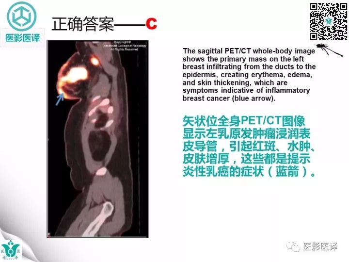 【病例】乳腺癌伴颅底转移至颈动脉管1例PET/CT