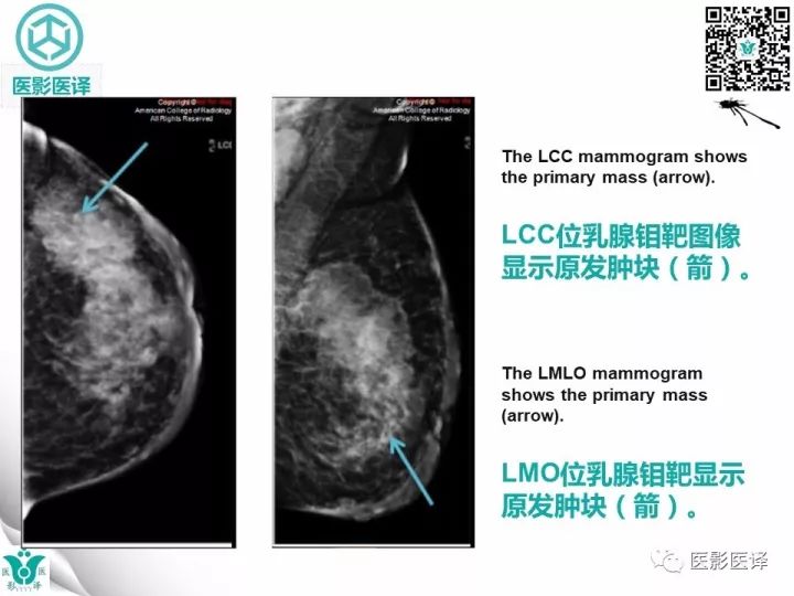 【病例】乳腺癌伴颅底转移至颈动脉管1例PET/CT