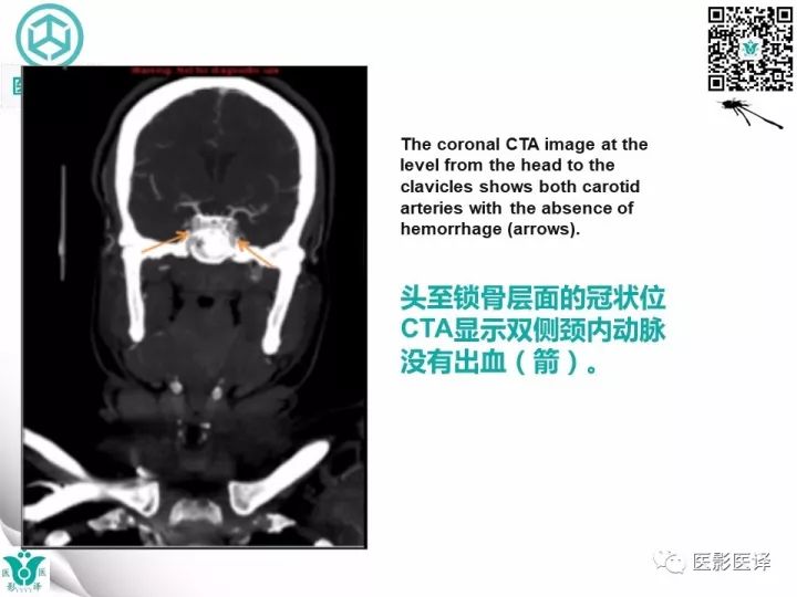 【病例】乳腺癌伴颅底转移至颈动脉管1例PET/CT