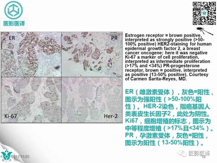 【病例】乳腺癌伴颅底转移至颈动脉管1例PET/CT