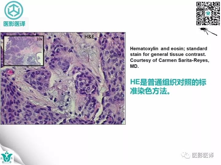 【病例】乳腺癌伴颅底转移至颈动脉管1例PET/CT