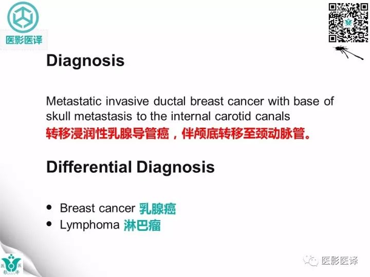 【病例】乳腺癌伴颅底转移至颈动脉管1例PET/CT