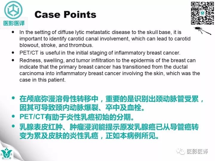 【病例】乳腺癌伴颅底转移至颈动脉管1例PET/CT