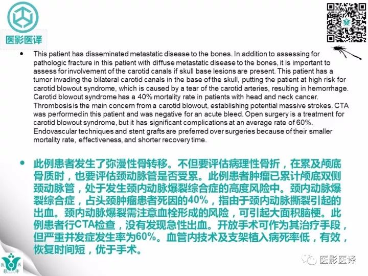 【病例】乳腺癌伴颅底转移至颈动脉管1例PET/CT
