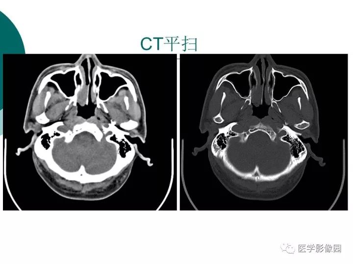 【病例】容易误诊为鼻息肉的