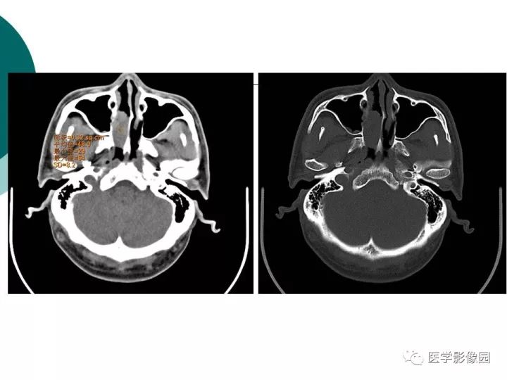 【病例】容易误诊为鼻息肉的