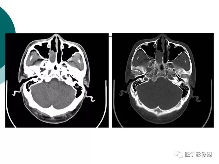 【病例】容易误诊为鼻息肉的