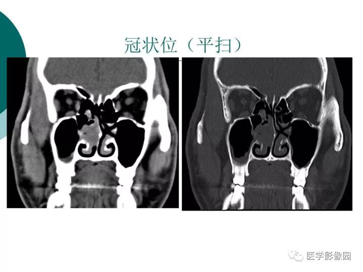 【病例】容易误诊为鼻息肉的