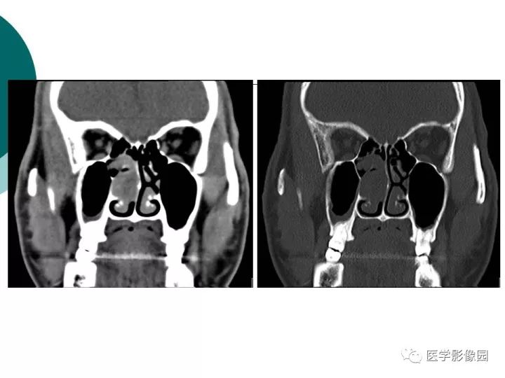 【病例】容易误诊为鼻息肉的