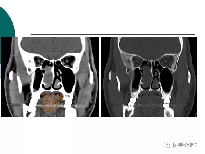 【病例】容易误诊为鼻息肉的