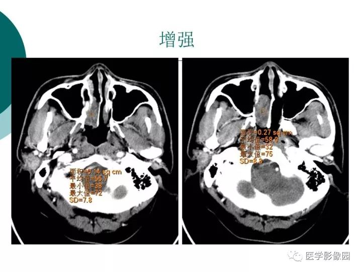 【病例】容易误诊为鼻息肉的