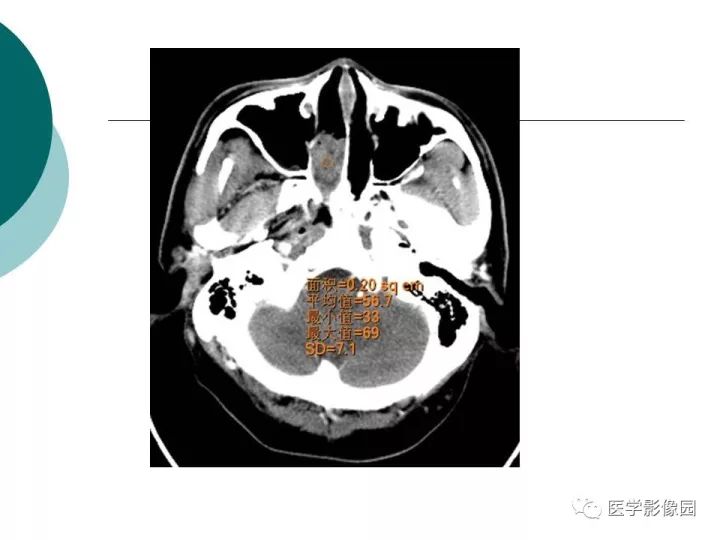 【病例】容易误诊为鼻息肉的