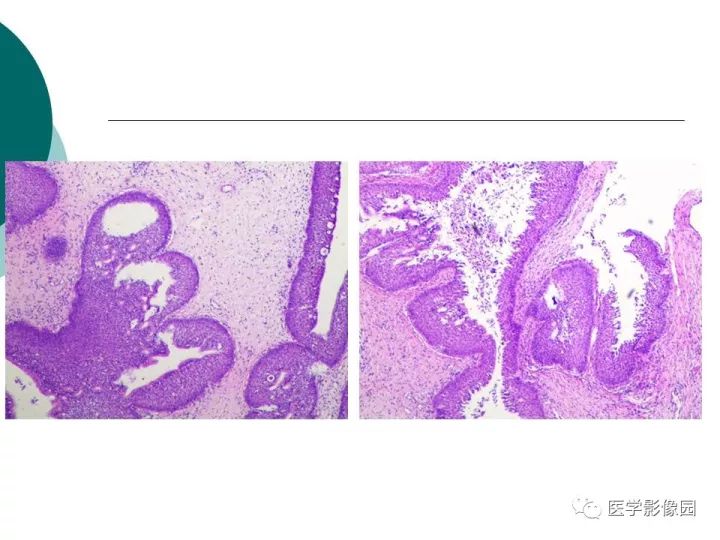 【病例】容易误诊为鼻息肉的